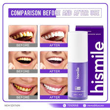 Teeth whitening